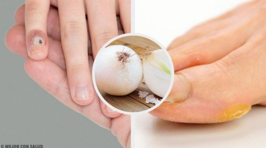 El ve ayaklarda çıkan nasırlardan doğal yolla nasıl kurturulur?