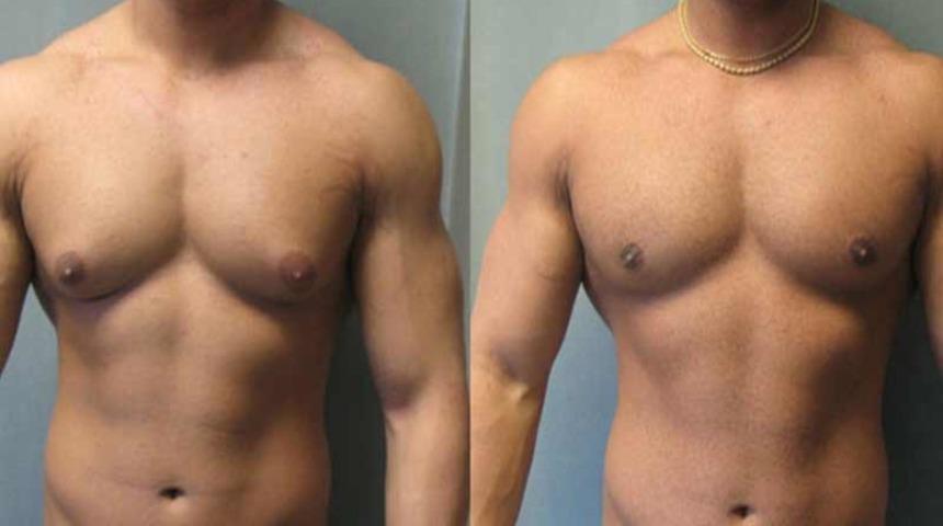 Jinekomasti ne demek? Jinekomasti neden olur? Jinekomasti ameliyatı sonrası ne yapmalı?