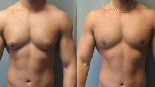 Jinekomasti ne demek? Jinekomasti neden olur? Jinekomasti ameliyatı sonrası ne yapmalı?