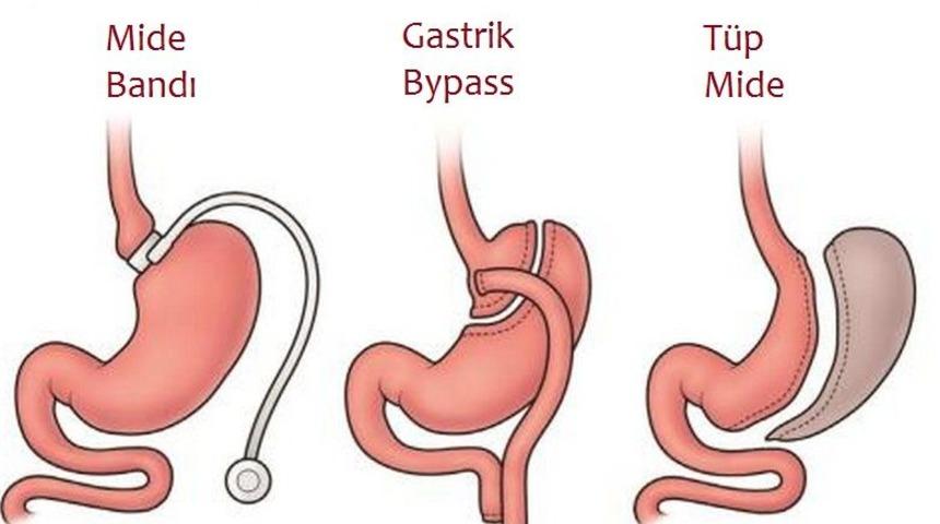 Obezite cerrahisinde t&uuml;p mide ameliyatı