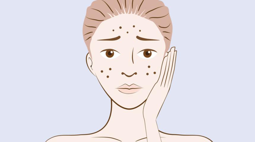 Akneleri Olan Her Kadının D&uuml;ş&uuml;nd&uuml;ğ&uuml; 16 Şey