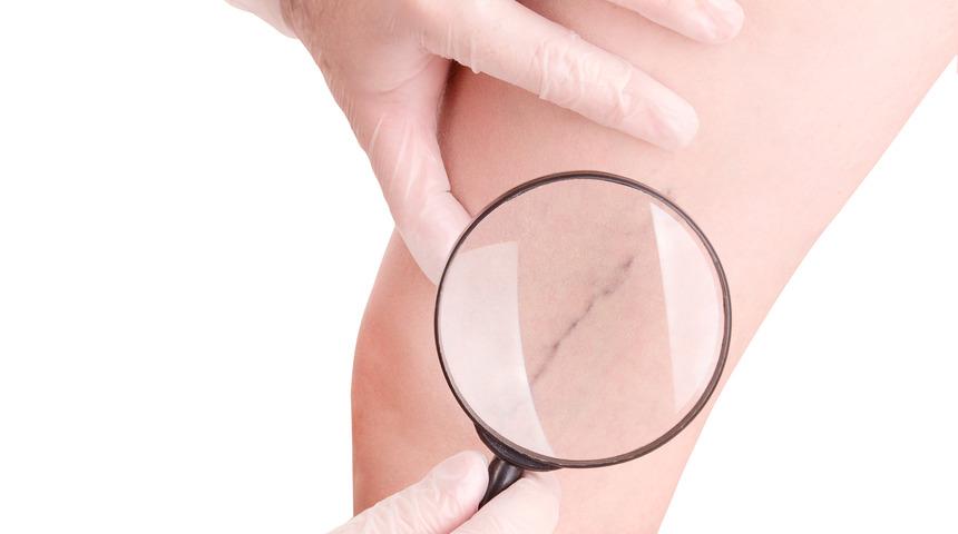 Varis nedir? Kimlerde meydana çıkar? Varisten korunma yolları nelerdir?