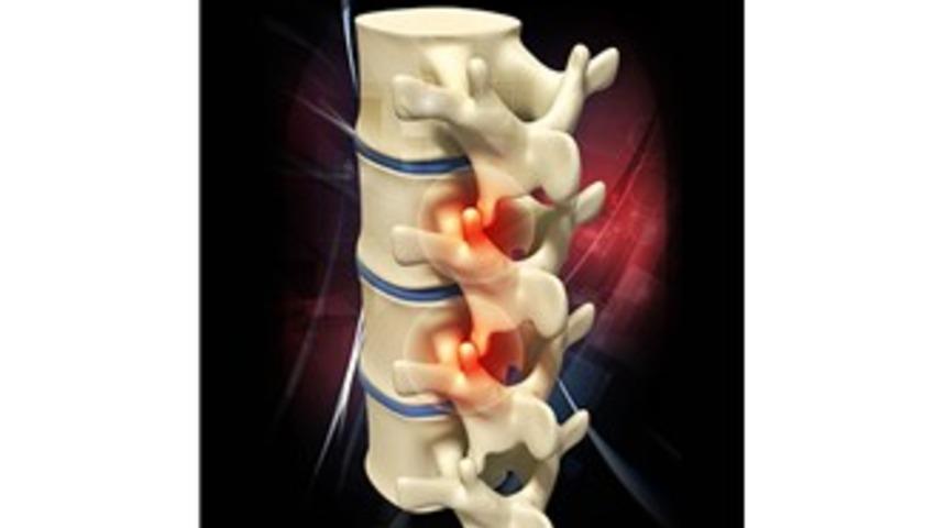 Faset sendromu: Kronik bel ağrılarının bilinmeyen nedeni