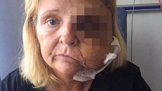 Et yiyen bakteri kadının yüzünü yedi 