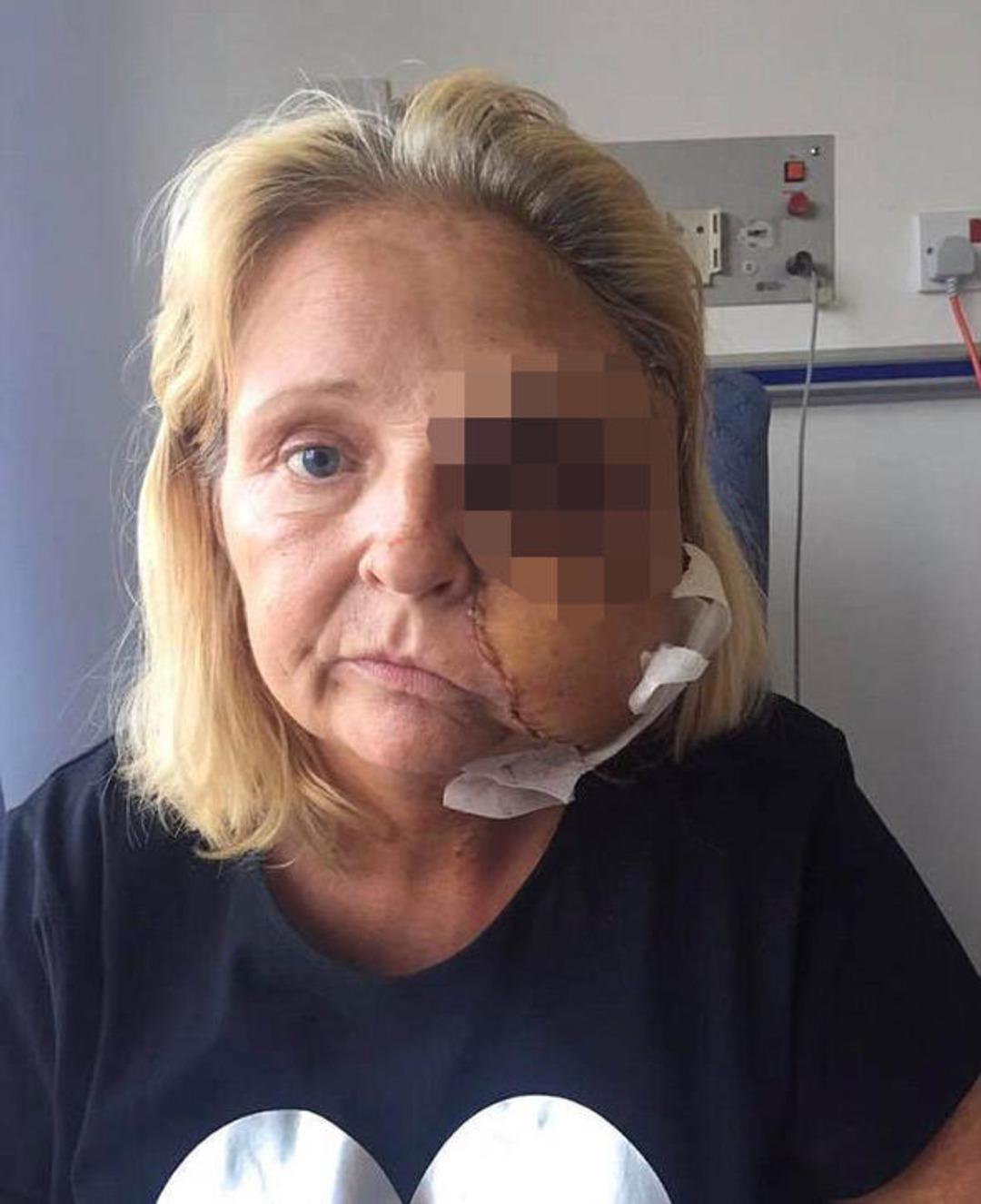 Et yiyen bakteri kadının y&uuml;z&uuml;n&uuml; yedi 