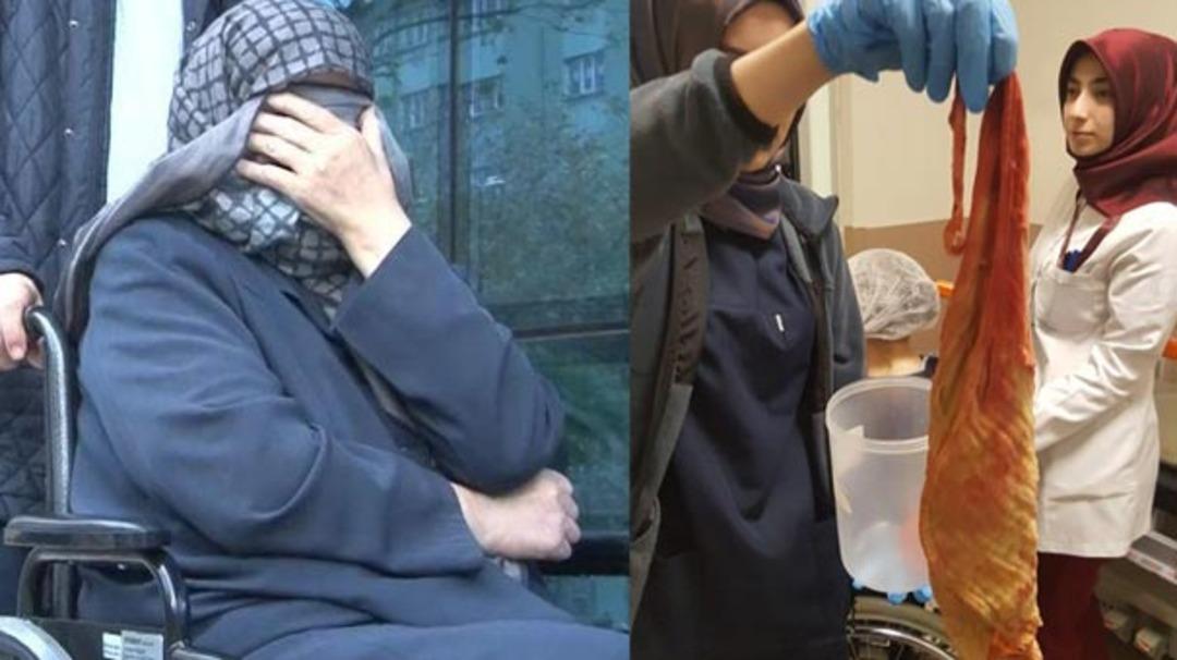 Karnından &ccedil;ıktı! Doktorlar bile şaşkına d&ouml;nd&uuml;