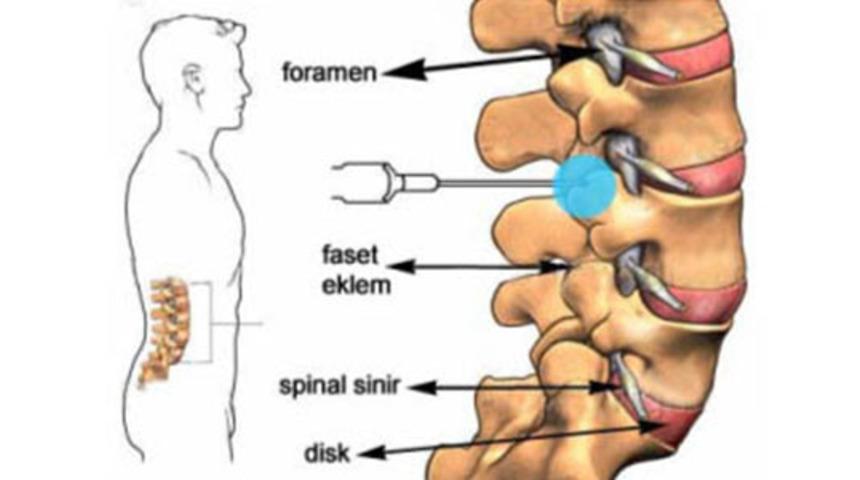 Faset Sendromu: Kronik Bel Ağrılarının Bilinmeyen Nedeni 