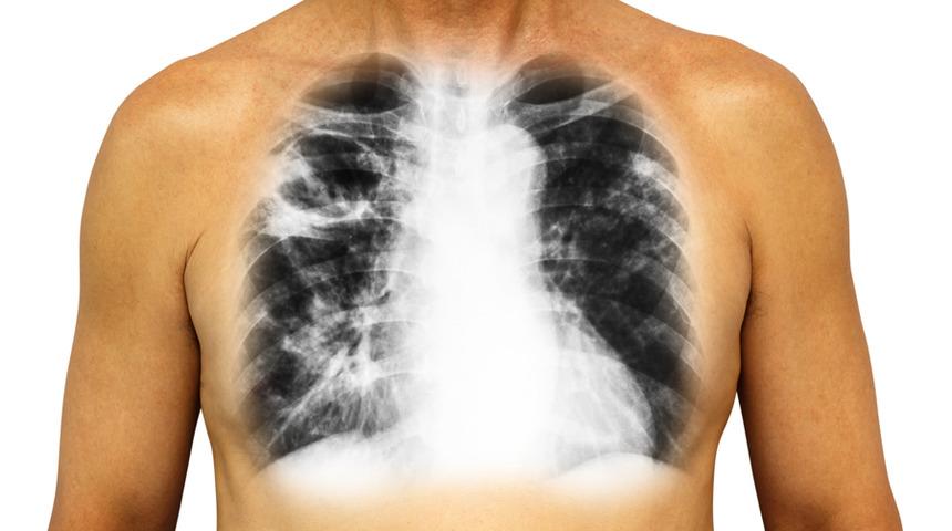 KOAH ölümcül bir hastalık mı? KOAH ölümleri engellenebilir mi? KOAH tedavisi büyük önem taşıyor