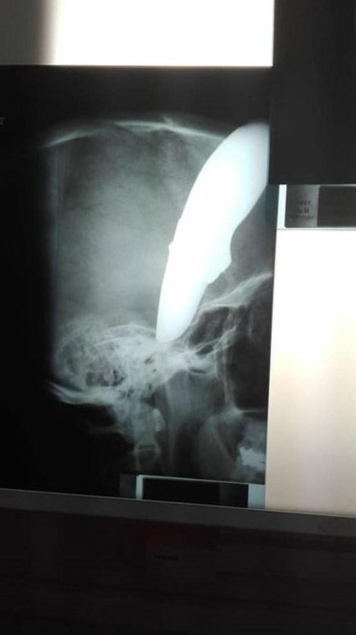 Başında 15 cm'lik bıçak saplı şekilde hastaneye geldi G1