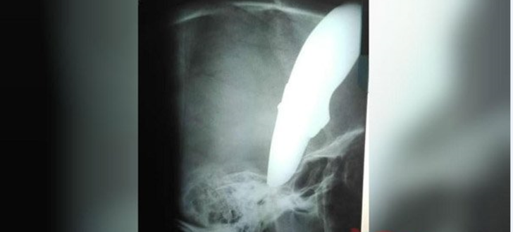 Başında 15 cm'lik bıçak saplı şekilde hastaneye geldi G3