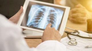 Tüberküloz nedir? Tüberküloz belirtileri ve tedavisi nasıl olur?