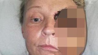 Çok tehlikeli! Et yiyen bakteri bu hale getirdi