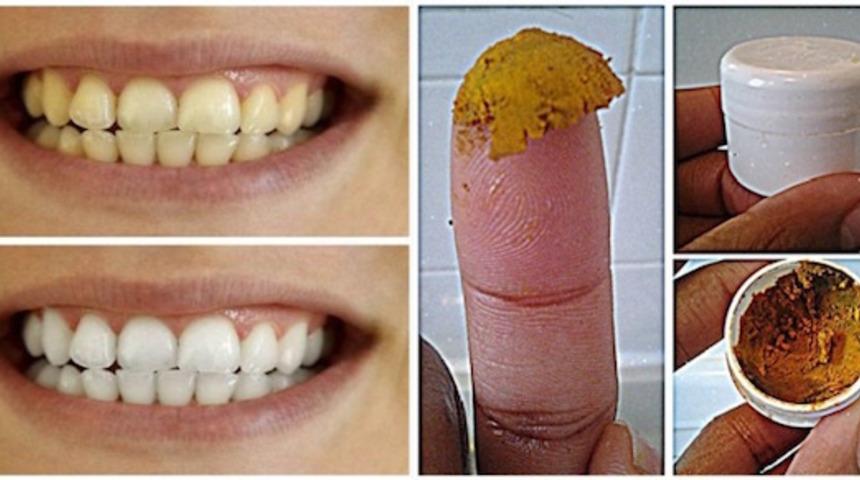 Herkes sırrınızı soracak! Diş beyazlatan zerde&ccedil;allı karışım