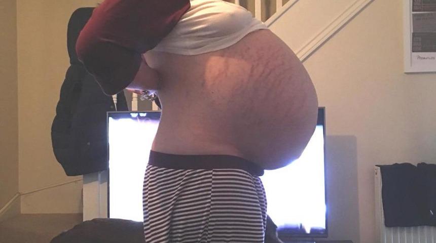 Herkes hamile zannetti! Karnından çıkan şey şoke etti