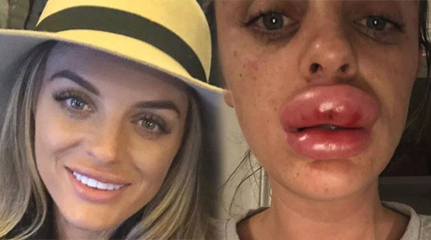 Botoks partisinde dudakları iki katı şişen kadın: Rachael 