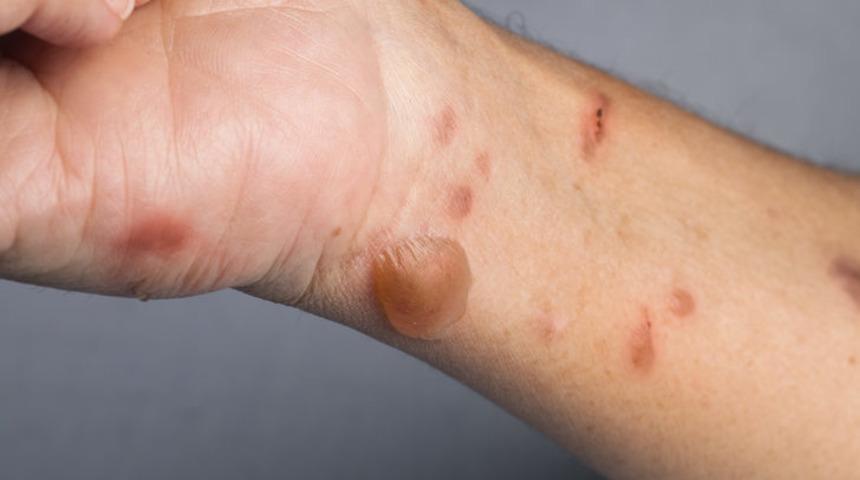 Yanıkta yapılması gerekenler