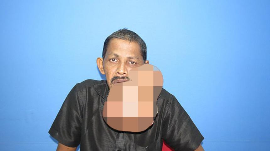 Yüzünden 5 kilogramlık tümör alındı! İnanılmaz değişim