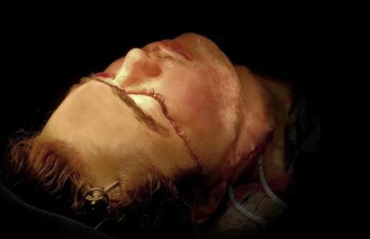 Yüzü paramparça olan gencin inanılmaz değişimi! G3