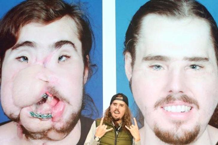 Yüzü paramparça olan gencin inanılmaz değişimi! G5