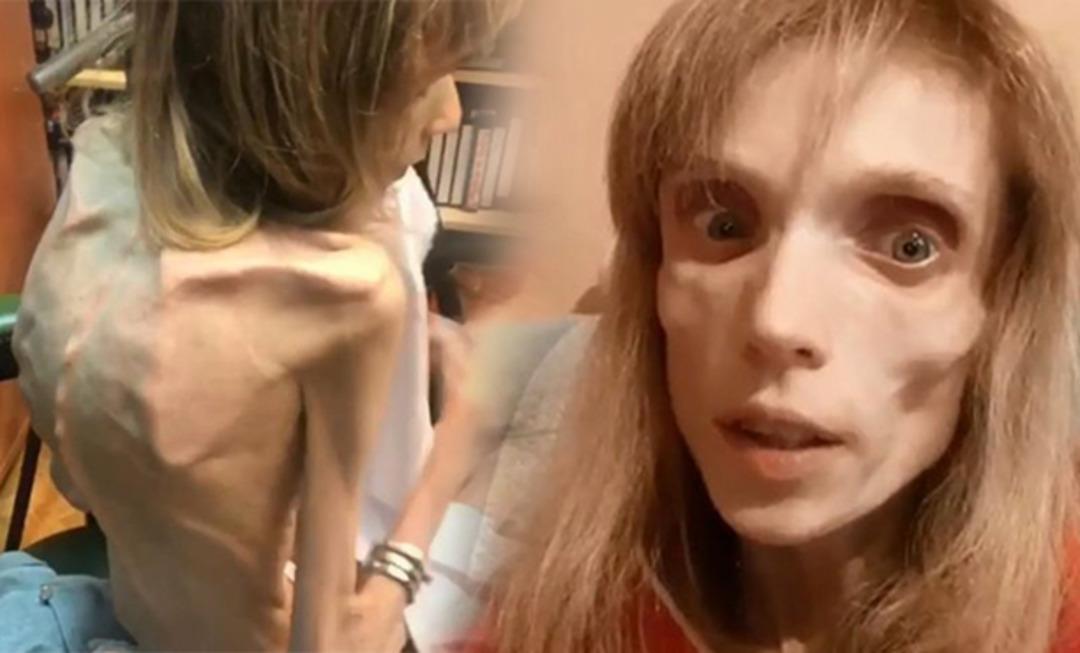 Anoreksiya hastası kadından g&uuml;zel haber geldi 