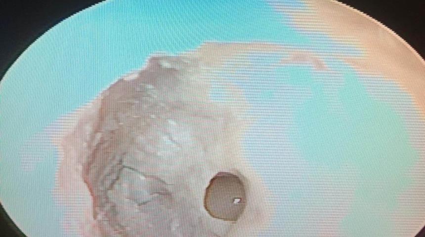 Kulak zarındaki delik, Salihli&rsquo;de onarıldı