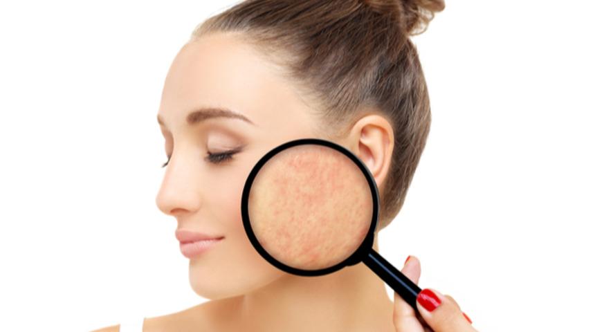 Yanık/yara izleri geçer mi?