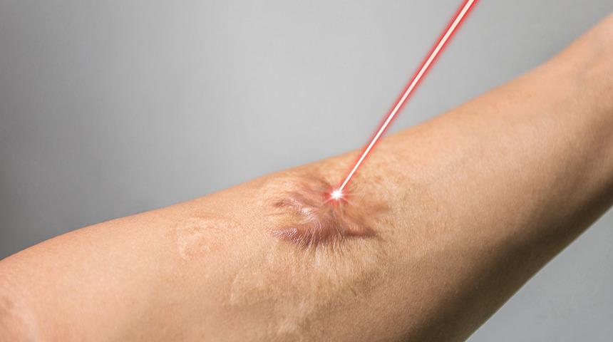 Yanık izi tedavisi nedir? Yanık izi nasıl geçer? Yanık izi kalmaması için ne yapmalı?