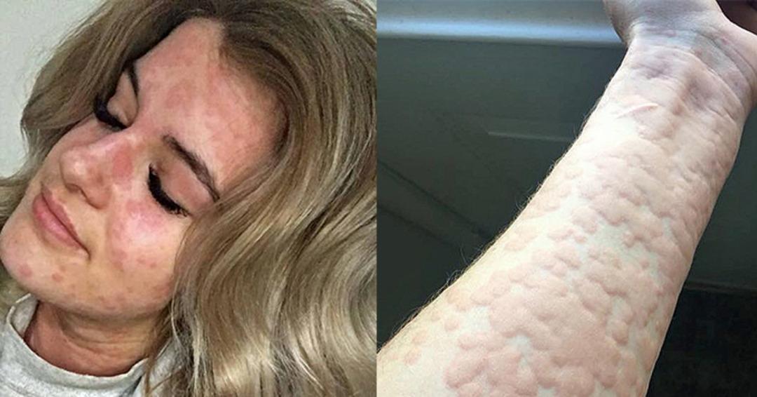 Kış alerjisi onu &ouml;ld&uuml;recek! &Uuml;ş&uuml;d&uuml;ğ&uuml; anda...