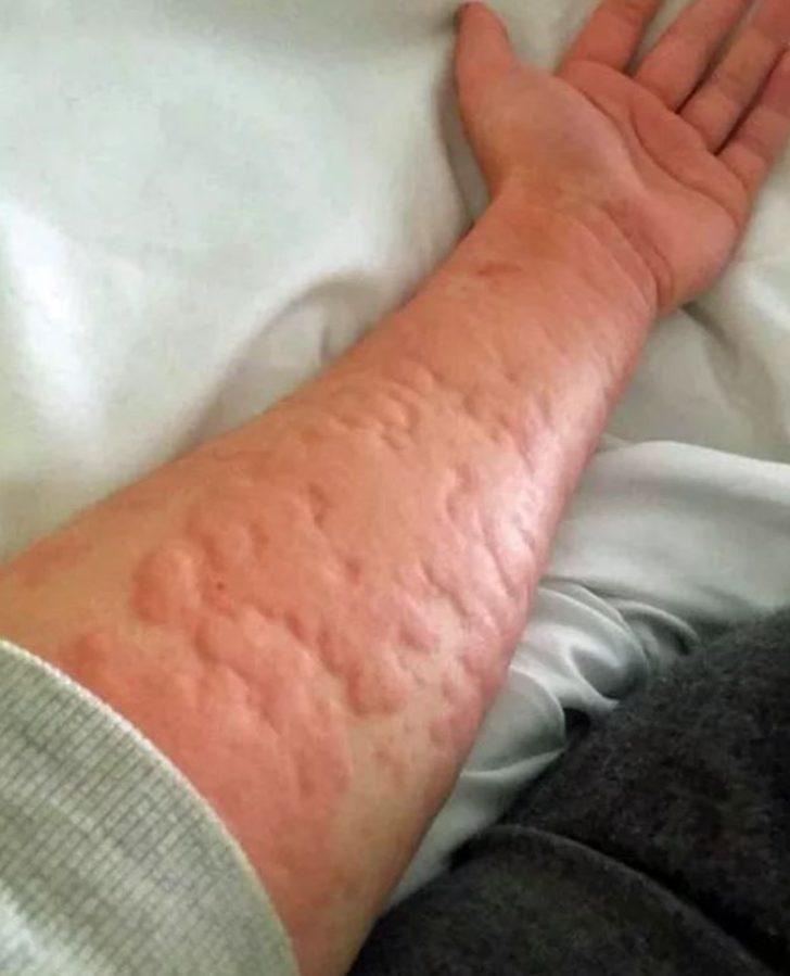 Kış alerjisi onu öldürecek! Üşüdüğü anda... G2