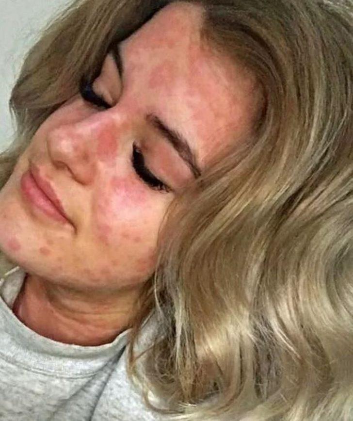 Kış alerjisi onu öldürecek! Üşüdüğü anda... G3