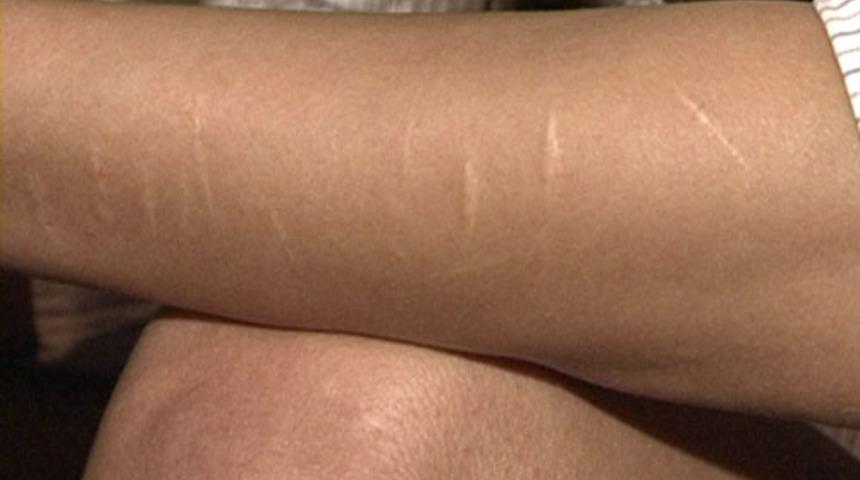 Faça ve jilet izlerinden nasıl kurtuluruz?