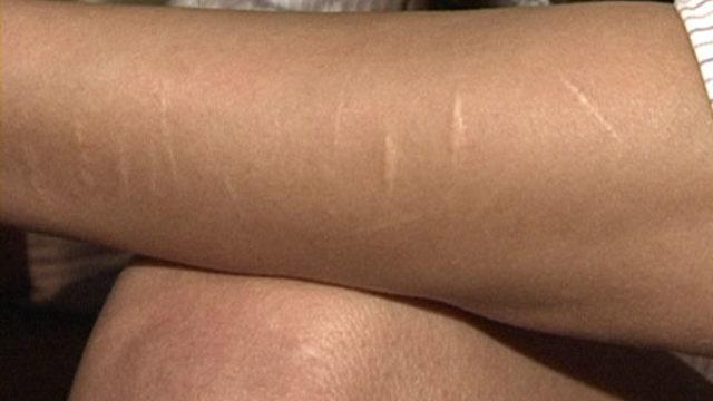 Faça ve jilet izlerinden nasıl kurtuluruz?