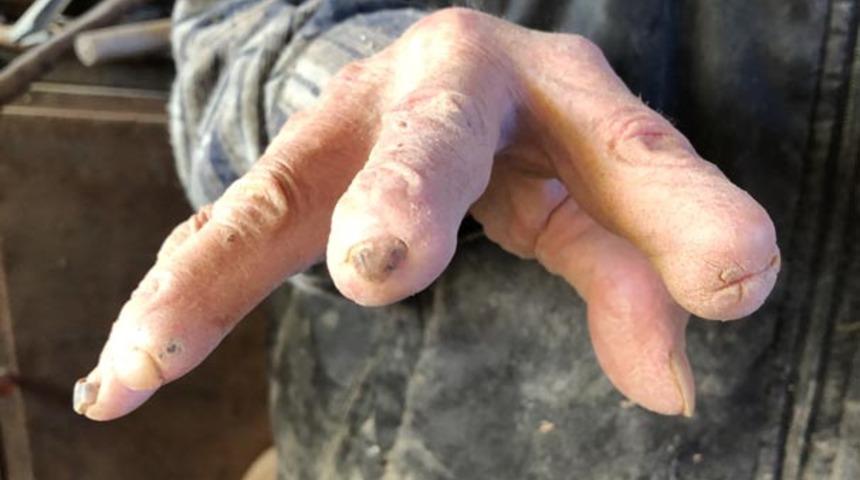 Bursa'da zorlu bir yaşam hikayesi! 72 yıldır &uuml;rettiği fı&ccedil;ılar y&uuml;z&uuml;nden elleri bu hale geldi