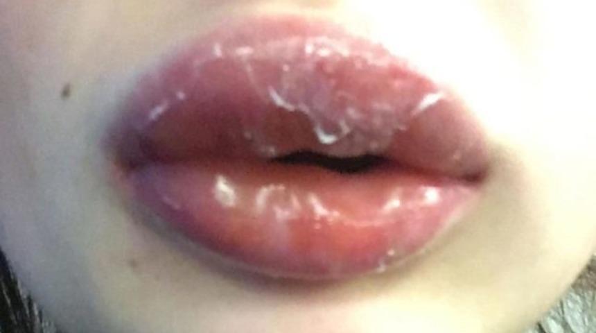 Dolgun dudak isterken, konuşamaz hale geldi