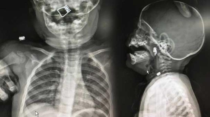 Dehşet! 1 yaşındaki bebeğin boğazında tespit edildi, doktorlar şaşkına döndü