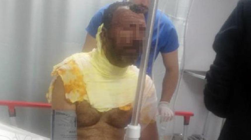 Antalya'da inanılmaz olay! Eşine kızıp kendini ateşe verdi, sebebi şoke etti