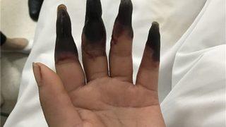 Aman dikkat! Ev işi yaptı iki gün sonra parmakları bu hale geldi