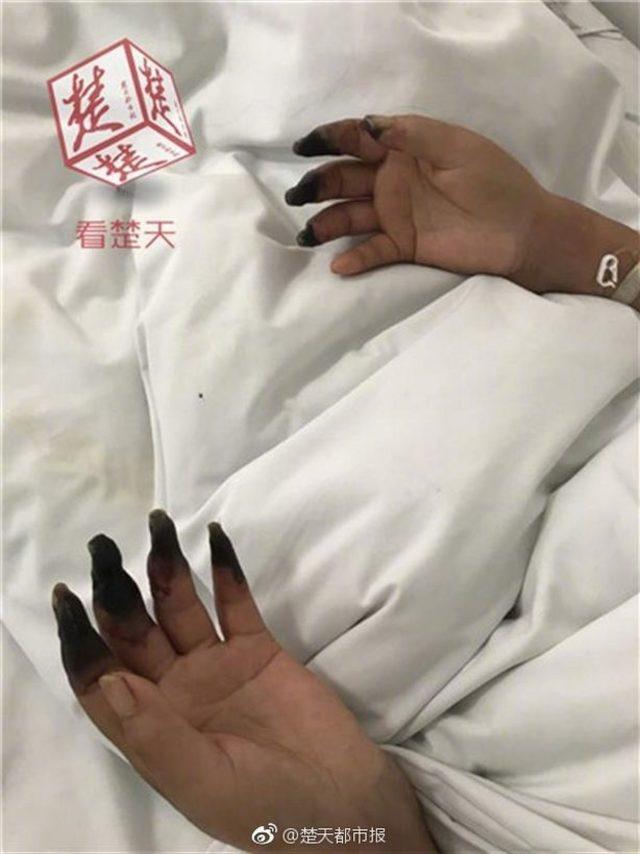1_Woman-has-eight-fingers-turned-into-black-after-cleaning (1)