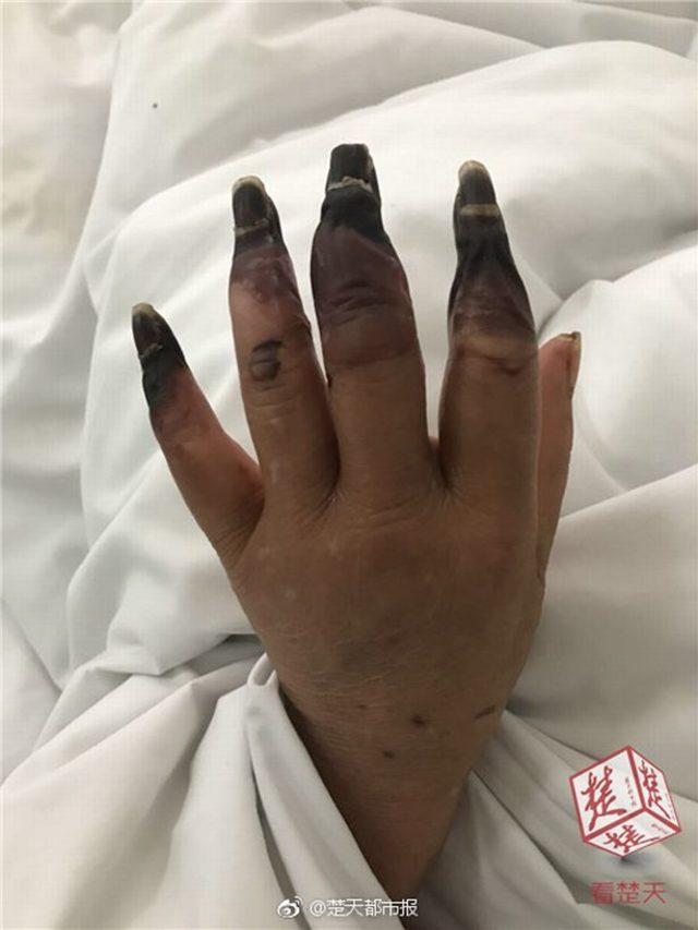 1_Woman-has-eight-fingers-turned-into-black-after-cleaning