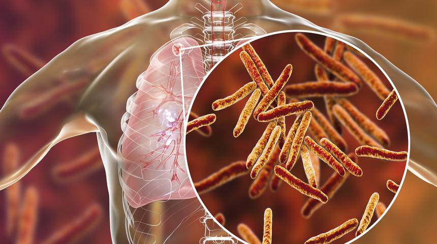 Verem (Tüberküloz) nedir? Verem hastalığı nasıl bulaşır? Metrobüste,uçakta dikkat! 