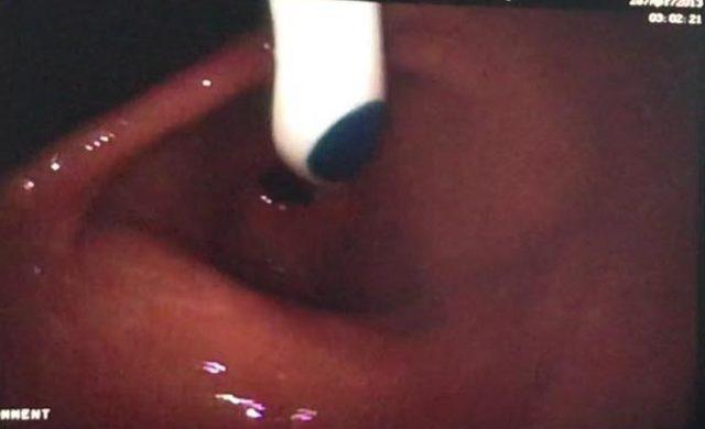 Kusmak için boğazına soktuğu diş fırçasını yuttu 2