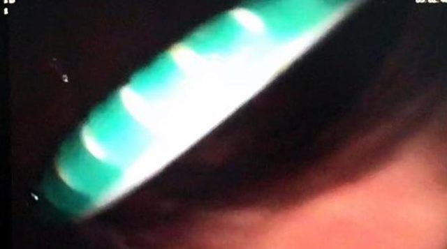 Kusmak için boğazına soktuğu diş fırçasını yuttu 3