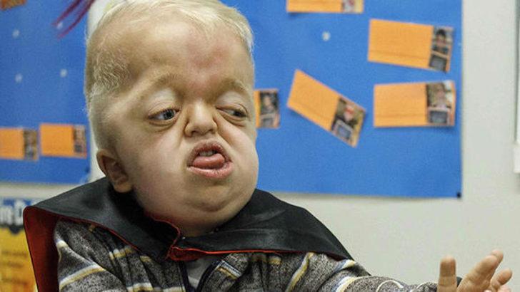 Bu hastalık dünyada yalnızca 30 kişide görülüyor G1