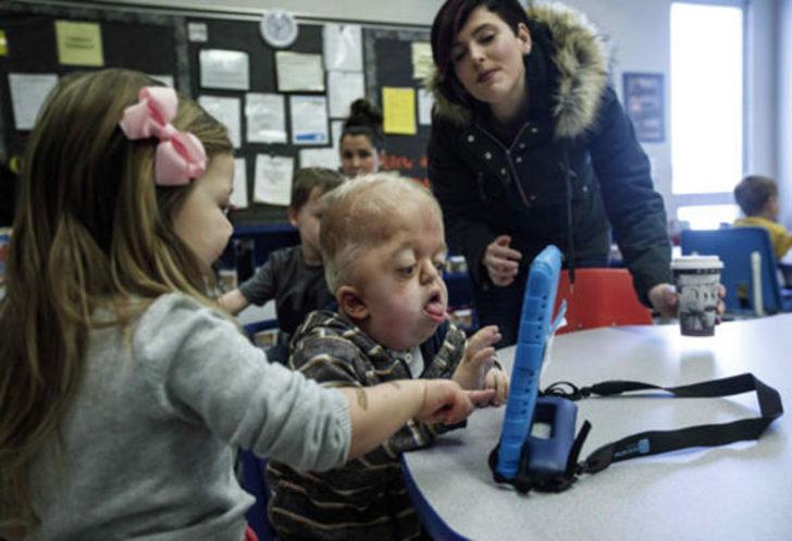 Bu hastalık dünyada yalnızca 30 kişide görülüyor G2