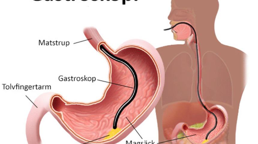 Gastroskopi ne demek? Gastroskopi ne zaman yapılır? Gastroskopide anestezi nasıl yapılır?