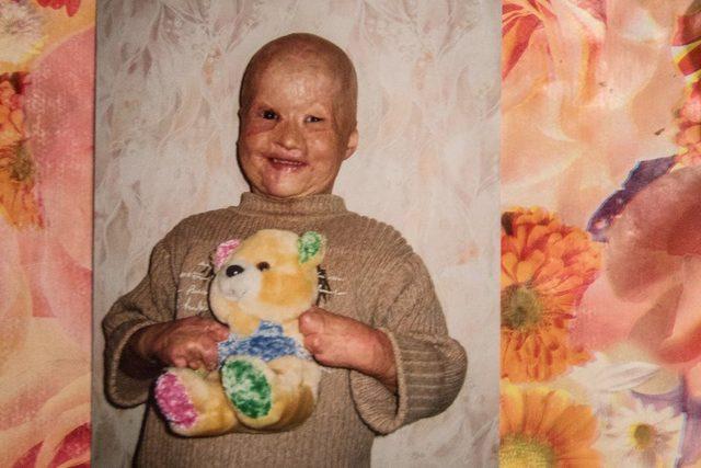 Babası iki yaşında odun sobasına attı! Şimdi k&uuml;llerinden doğdu 4