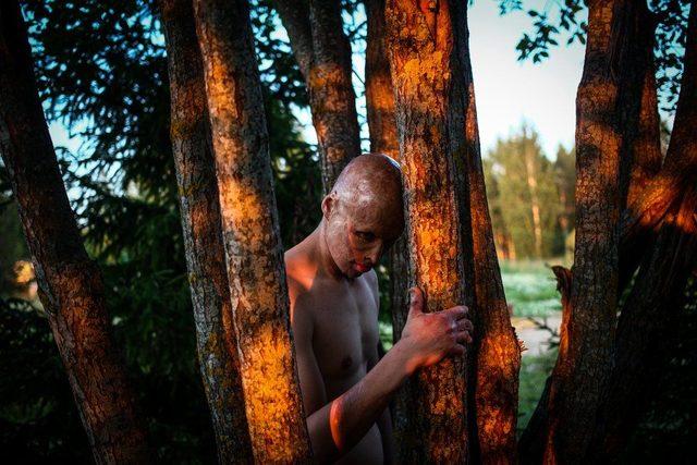 Babası iki yaşında odun sobasına attı! Şimdi k&uuml;llerinden doğdu 6
