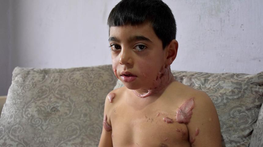 Sira&ccedil;, v&uuml;cudundaki yanıklar y&uuml;z&uuml;nden okula gitmiyor