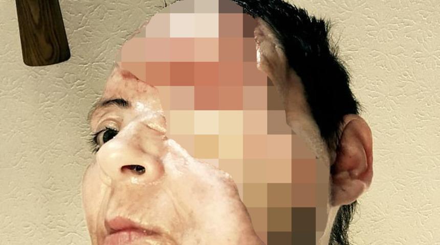 Yüzünde havai fişek patladı, hayatı karardı!