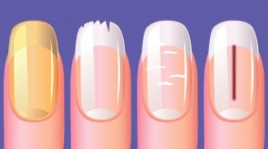 Tırnak deyip ge&ccedil;meyin! Ojemizin rengi kadar tırnaklarımızdan gelen işaretlere de dikkat etmeliyiz
